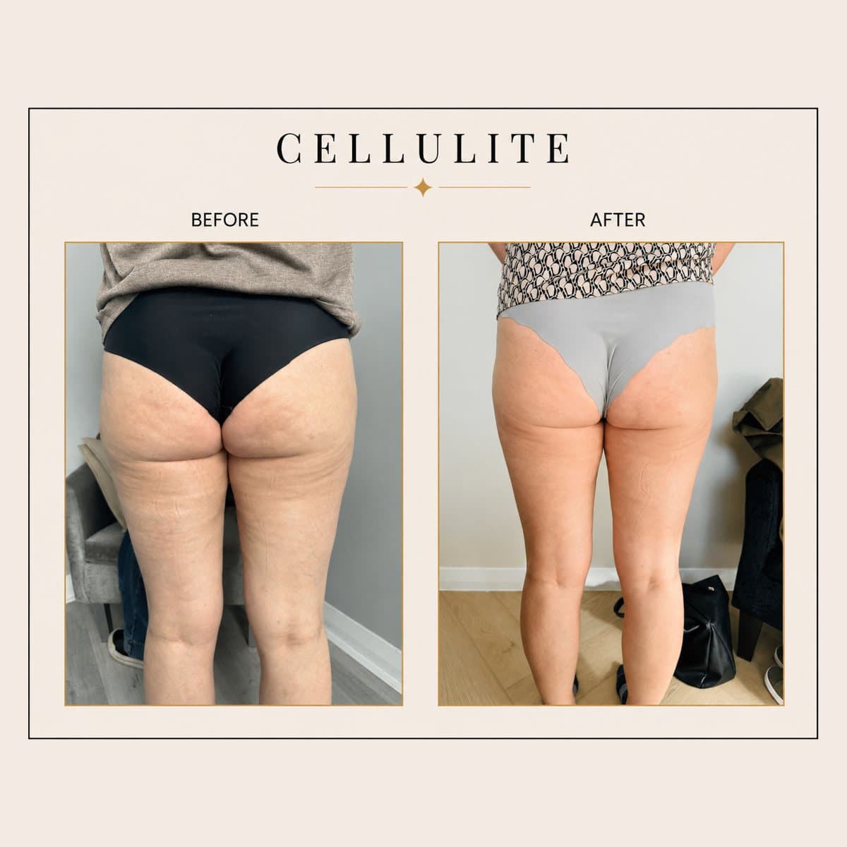 Cellulite Reduction before and after at Totally Transformed Newcastle, thighs and glutes