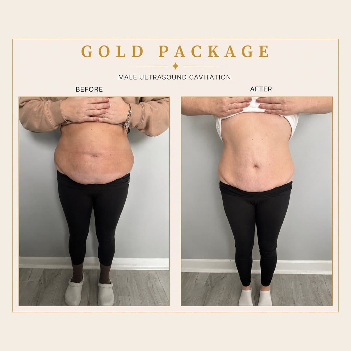 Ultrasound Cavitation before and after at Totally Transformed Newcastle, gold package