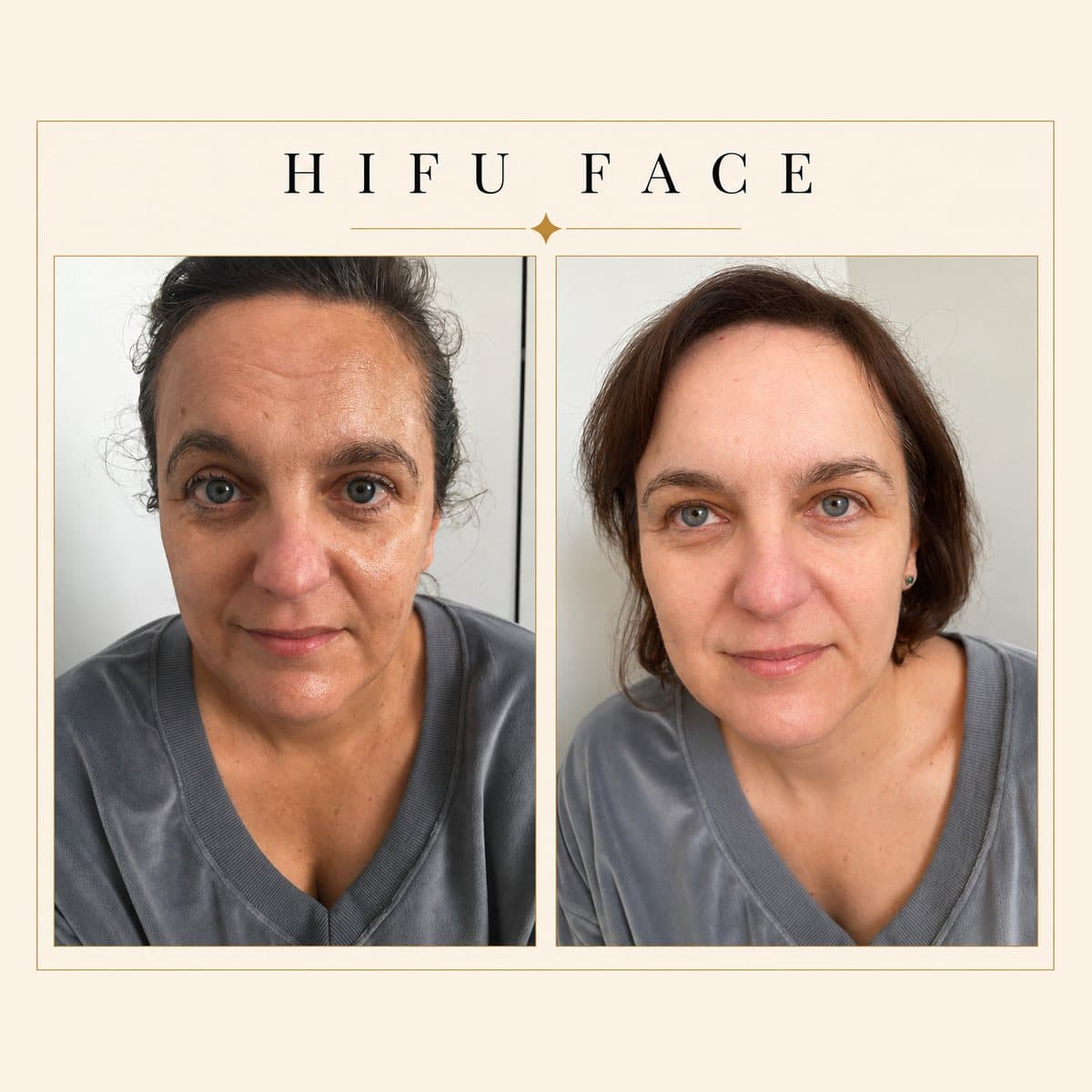 HIFU Ultra Facelift before and after at Totally Transformed Newcastle, skin texture and firmness