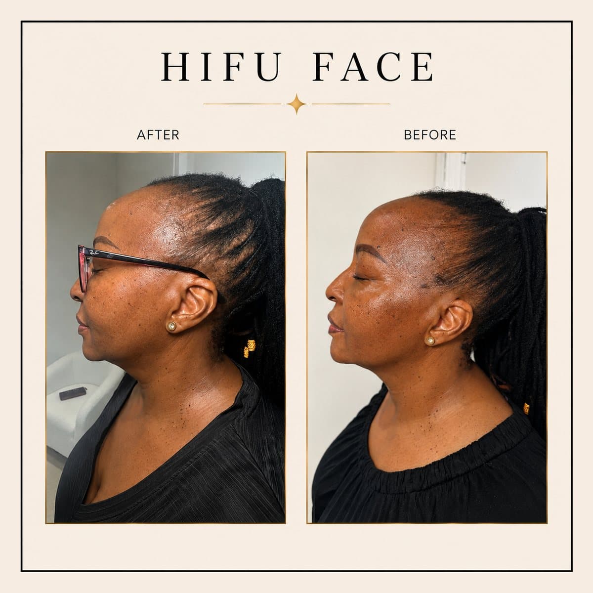 HIFU Ultra Facelift before and after at Totally Transformed Newcastle, face