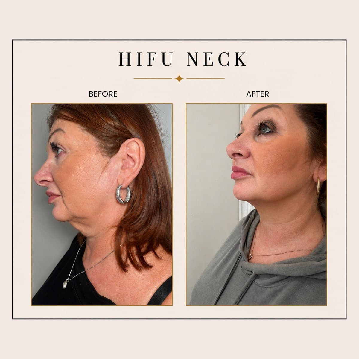 HIFU Ultra Facelift before and after at Totally Transformed Newcastle, neck