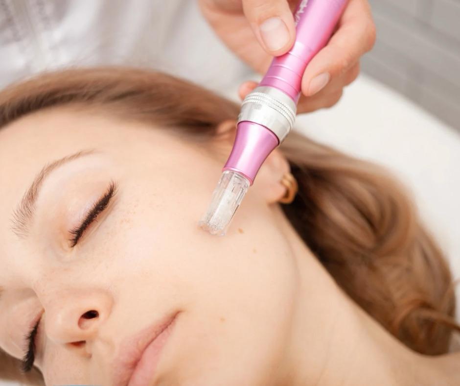 WhatsApp Image 2025-04-11 at 11.54.22_fe9895c6 microneedling. an image of a woman with a microneedling device resting on her face.